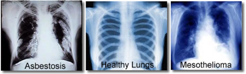 x-rays showing the various effects of asbestos on lungs